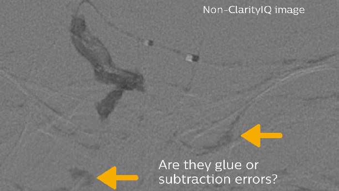 Erro de cola e de subtra&ccedil;&atilde;o