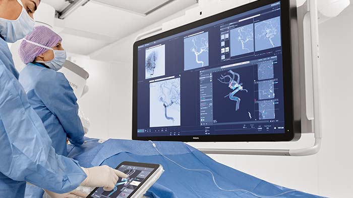 Tratamento de aneurisma cerebral