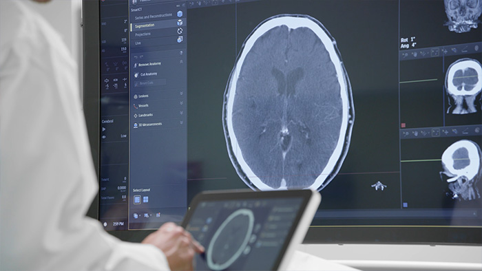 Tratamento de AVC isquêmico