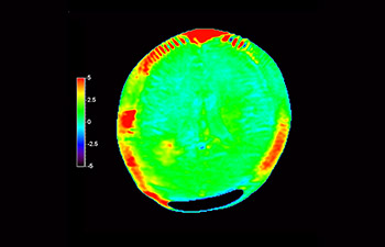 Reincid&ecirc;ncia de glioblastoma