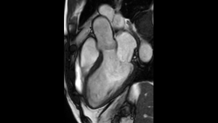 bTFE left ventricular outflow tract (download .jpg)