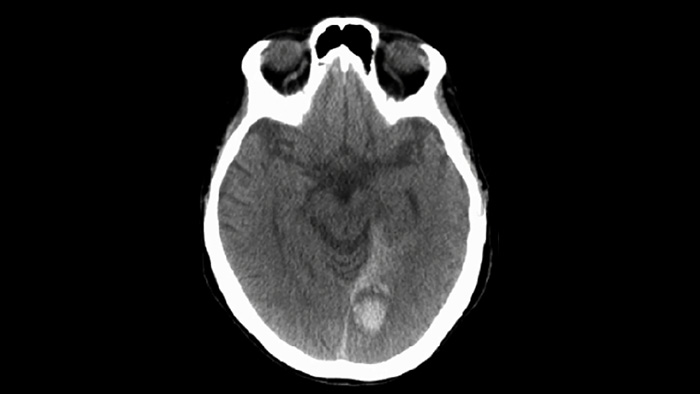 CBCT (semelhante &agrave; TC)